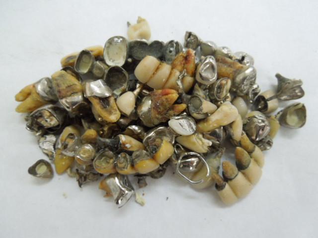 歯科金属屑・歯科スクラップ金属(撤去冠・除去冠)