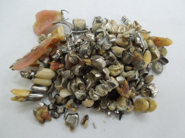 歯科金属屑・歯科スクラップ金属(撤去冠・除去冠)