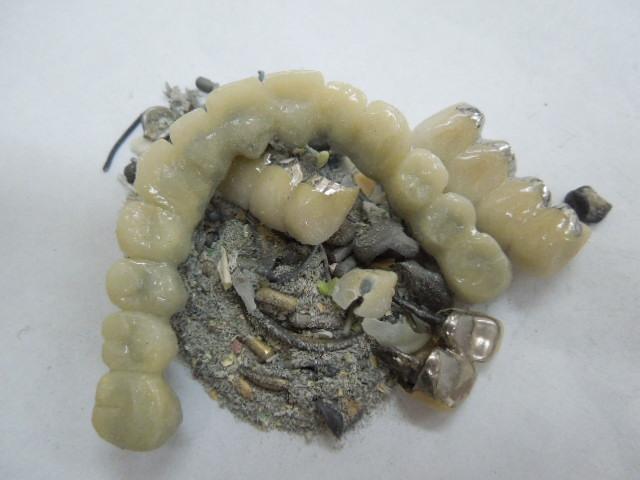 歯科金属屑・歯科スクラップ金属(撤去冠・除去冠)