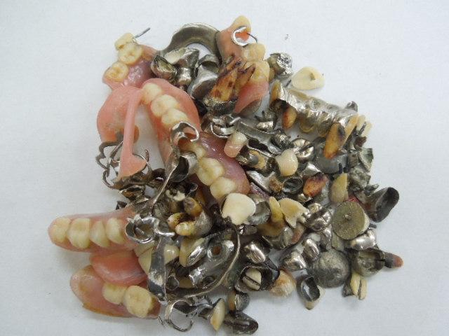 歯科金属屑・歯科スクラップ金属(撤去冠・除去冠)