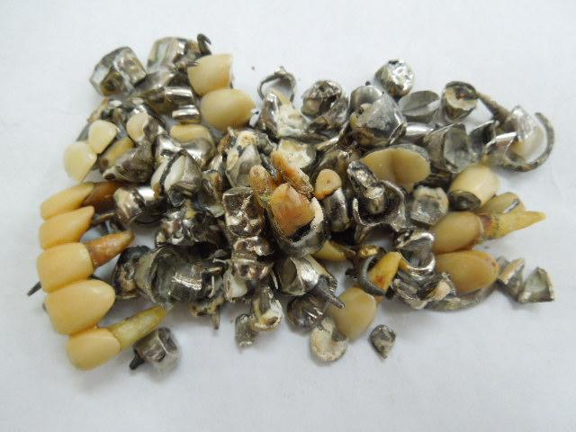 歯科金属屑・歯科スクラップ金属(撤去冠・除去冠)