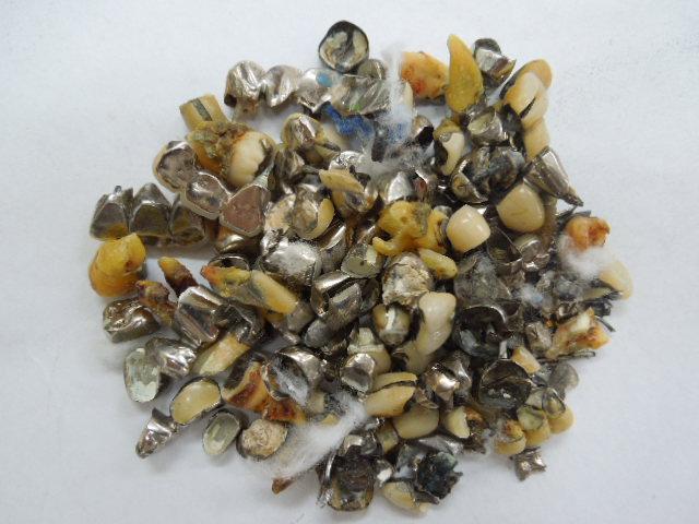 歯科金属屑・歯科スクラップ金属(撤去冠・除去冠)