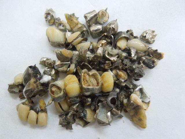 歯科金属屑・歯科スクラップ金属(撤去冠・除去冠)