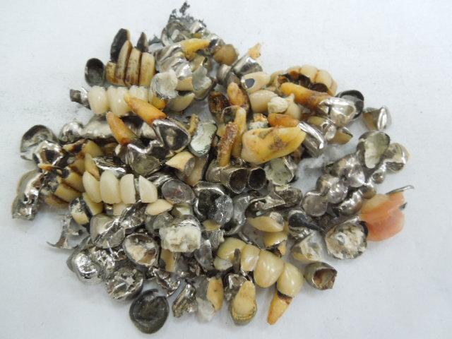 歯科金属屑・歯科スクラップ金属(撤去冠・除去冠)