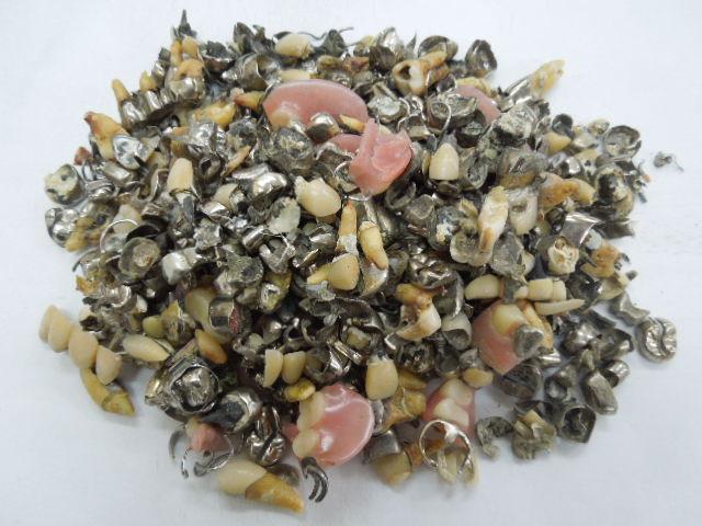 歯科金属屑・歯科スクラップ金属(撤去冠・除去冠)