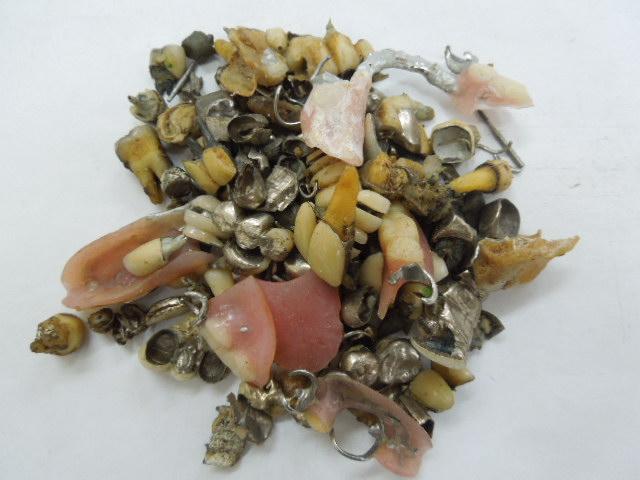 歯科金属屑・歯科スクラップ金属(撤去冠・除去冠)