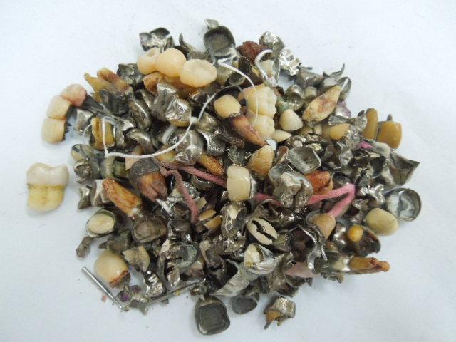 歯科金属屑・歯科スクラップ金属(撤去冠・除去冠)