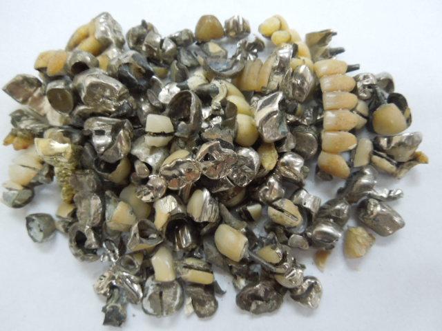 歯科金属屑・歯科スクラップ金属(撤去冠・除去冠)