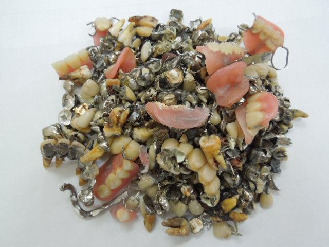 歯科金属屑・歯科スクラップ金属(撤去冠・除去冠)