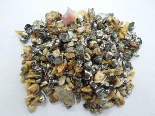 歯科金属屑・歯科スクラップ金属(撤去冠・除去冠)