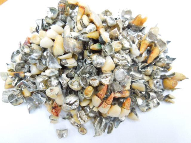 歯科金属屑・歯科スクラップ金属(撤去冠・除去冠)