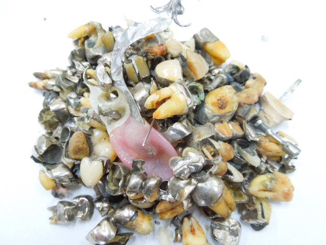 歯科金属屑・歯科スクラップ金属(撤去冠・除去冠)