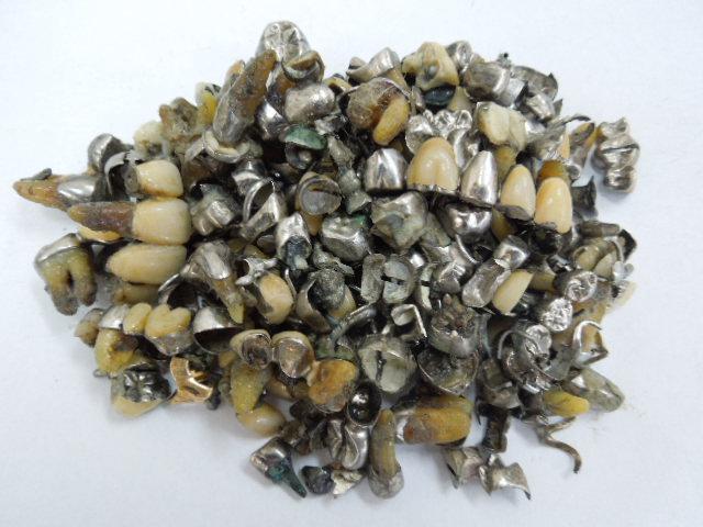 歯科金属屑・歯科スクラップ金属(撤去冠・除去冠)