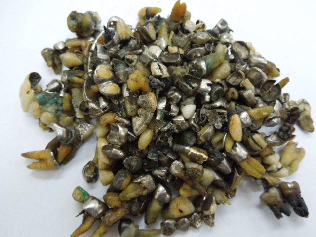 歯科金属屑・歯科スクラップ金属(撤去冠・除去冠)