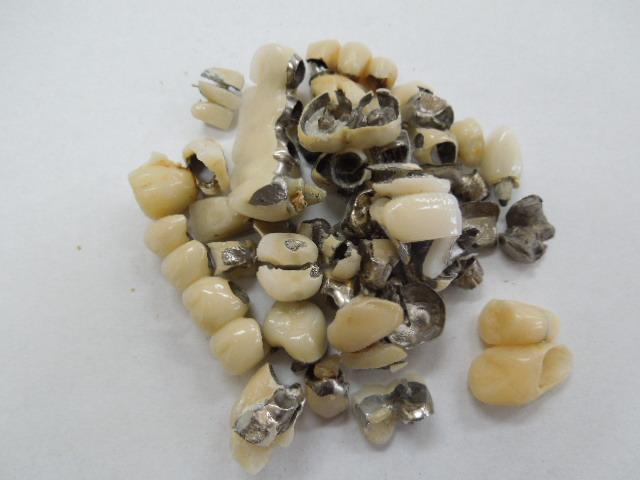 歯科金属屑・歯科スクラップ金属(撤去冠・除去冠)