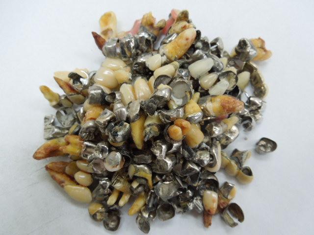 歯科金属屑・歯科スクラップ金属(撤去冠・除去冠)