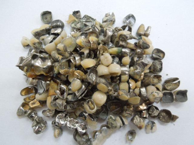 歯科金属屑・歯科スクラップ金属(撤去冠・除去冠)