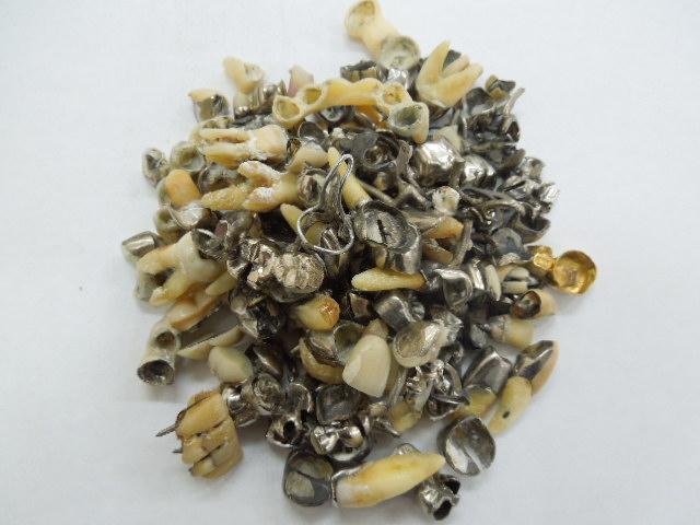 歯科金属屑・歯科スクラップ金属(撤去冠・除去冠)