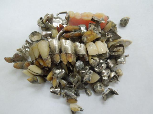 歯科金属屑・歯科スクラップ金属(撤去冠・除去冠)