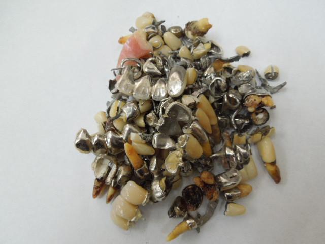 歯科金属屑・歯科スクラップ金属(撤去冠・除去冠)