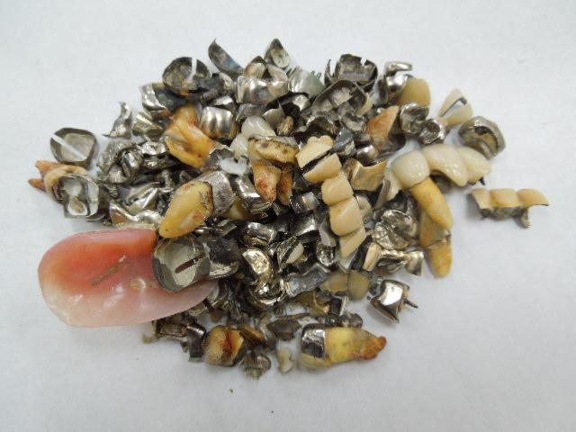 歯科金属屑・歯科スクラップ金属(撤去冠・除去冠)