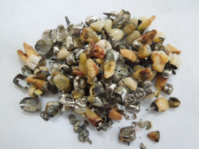 歯科金属屑・歯科スクラップ金属(撤去冠・除去冠)