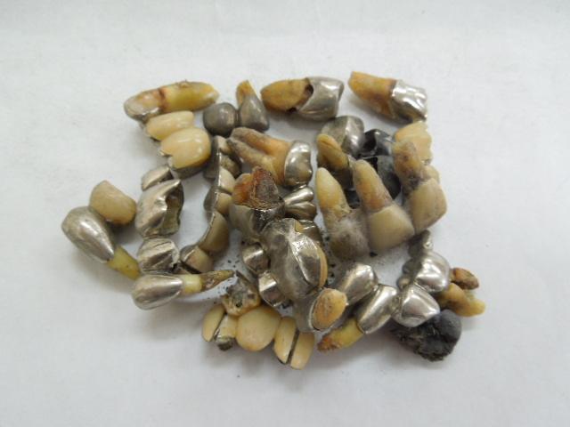 歯科金属屑・歯科スクラップ金属(撤去冠・除去冠)