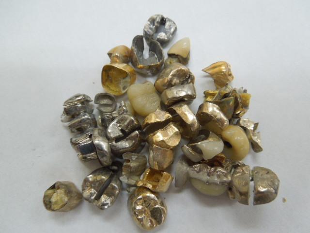 歯科金属屑・歯科スクラップ金属(撤去冠・除去冠)