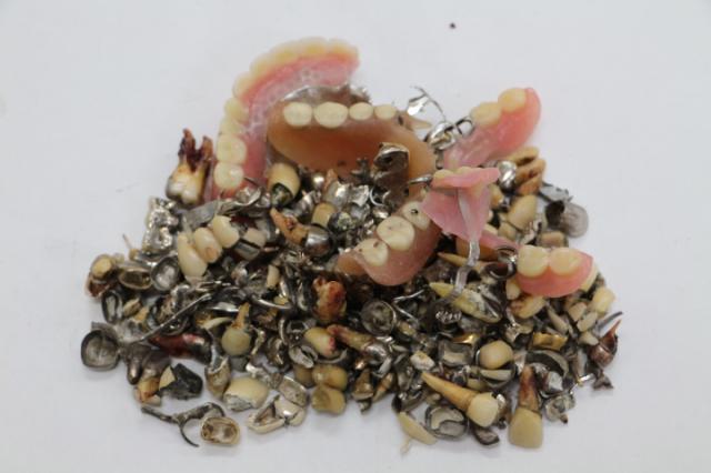 歯科金属屑・歯科スクラップ金属(撤去冠・除去冠)