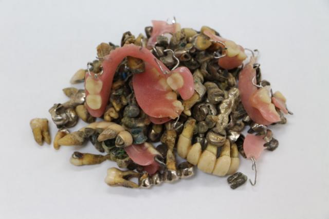 歯科金属屑・歯科スクラップ金属(撤去冠・除去冠)