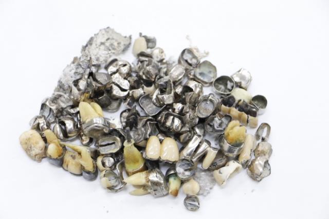 歯科金属屑・歯科スクラップ金属(撤去冠・除去冠)