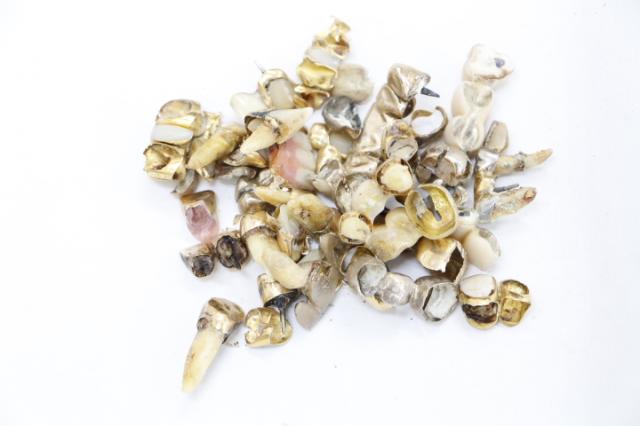 歯科金属屑・歯科スクラップ金属(撤去冠・除去冠)